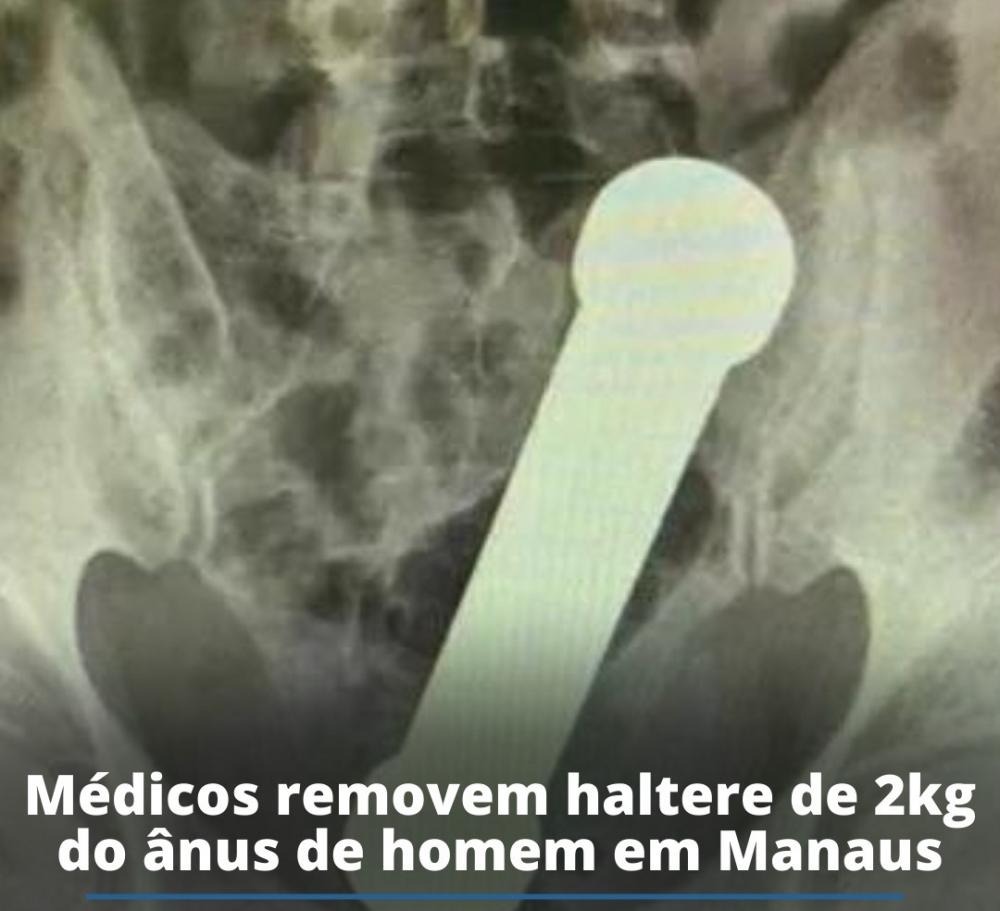 Homem de 54 anos, tem haltere de 2 kg removido do ânus em Manaus