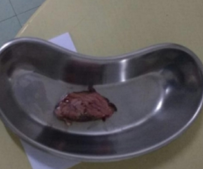 Mulher morre após engasgar com pedaço de carne